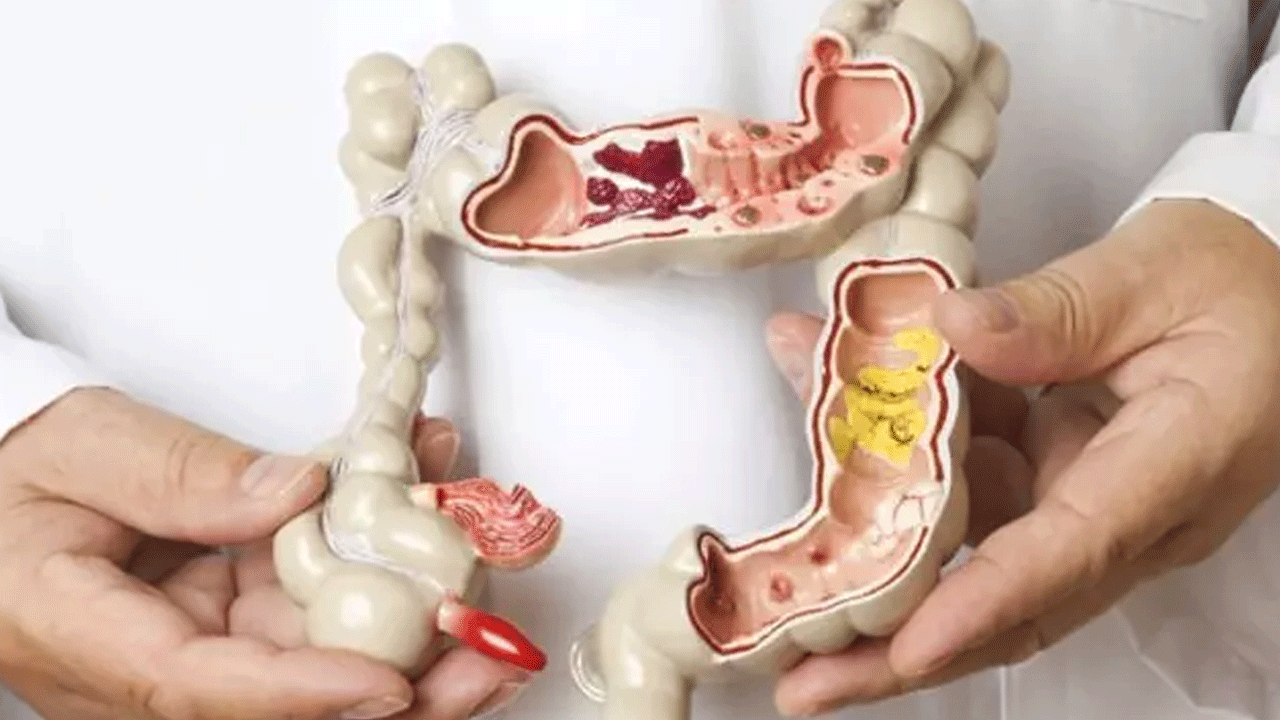 Foto - ABD'li doktor 'bunları mutlaka tüketin' dedi: İşte kolon kanserine iyi gelen besinler!