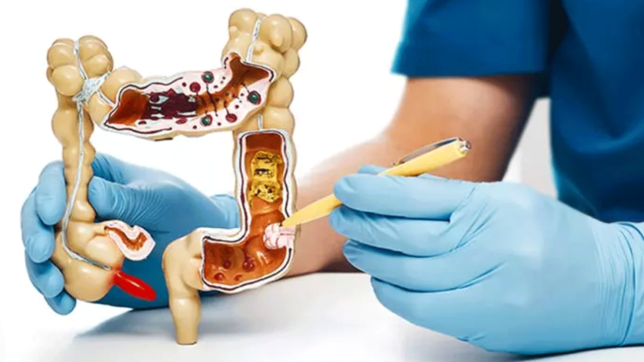 ABD'li doktor 'bunları mutlaka tüketin' dedi: İşte kolon kanserine iyi gelen besinler!