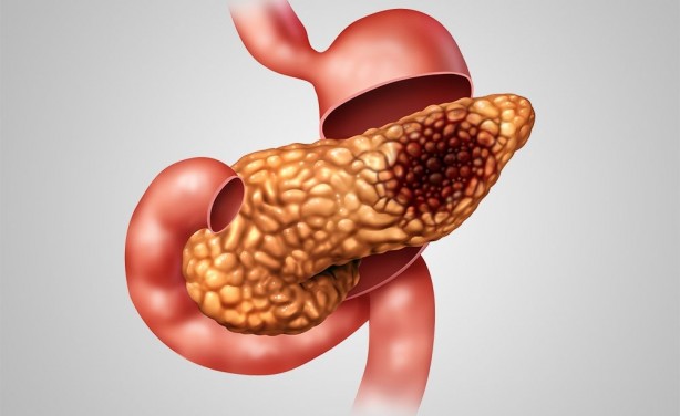 ABD'li doktorlar doktorlar uyardı! İşte pankreas kanseri olmamak için uzak durmamız gerekenler