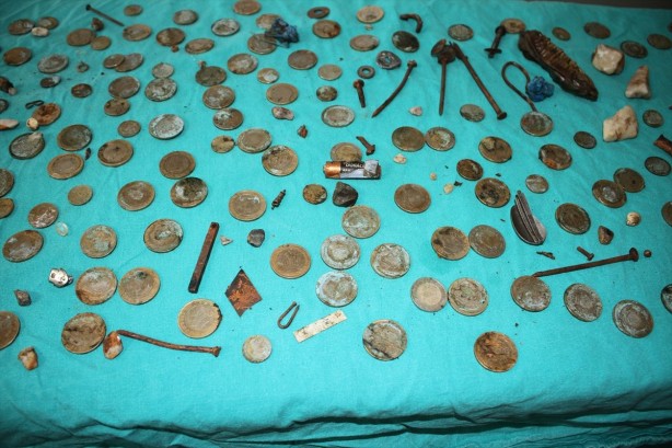 Foto - Adamın midesinden çıkanlar şoke etti!