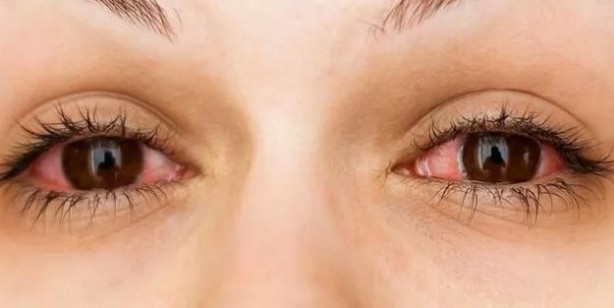 Foto - Adenovirüs gözlerimizi tehdit ediyor