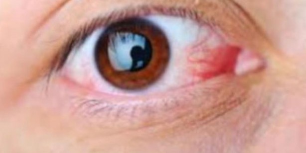 Foto - Adenovirüs gözlerimizi tehdit ediyor