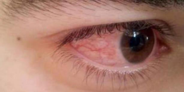 Adenovirüs gözlerimizi tehdit ediyor