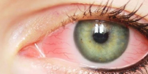 Foto - Adenovirüs gözlerimizi tehdit ediyor