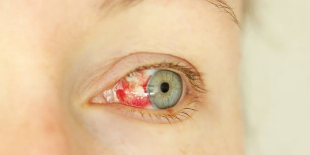 Foto - Adenovirüs gözlerimizi tehdit ediyor