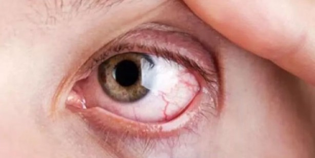 Foto - Adenovirüs gözlerimizi tehdit ediyor