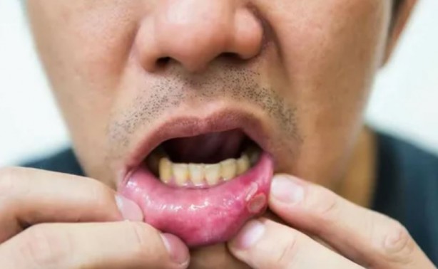 Ağız içinde çıkan yaralara dikkat! Kanser tehlikesiyle karşı karşıya olabilirsiniz