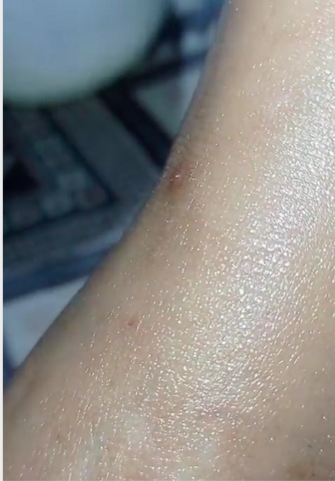 Foto - Ağızlarından, burunlarından kurtçuklar düşüyor! Sebebi şok etti! Yaşadıkları inanılmaz