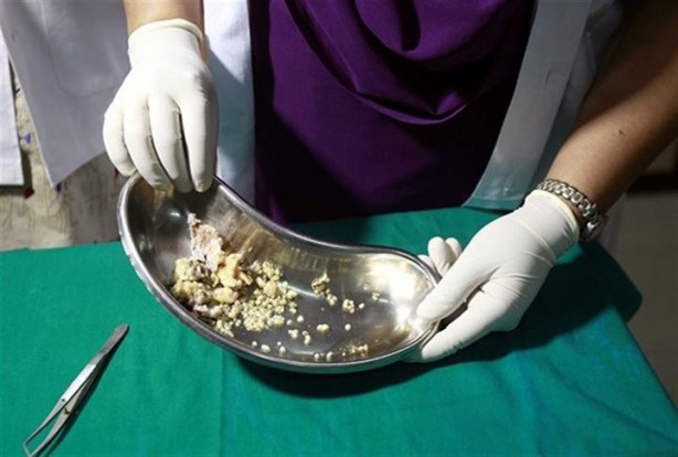 Foto - Ağzından tam 232 diş çıkarıldı