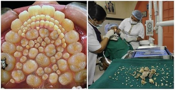 Foto - Ağzından tam 232 diş çıkarıldı