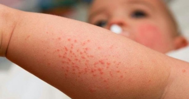 Foto - Aileler dikkat! En çok çocukları etkiliyor