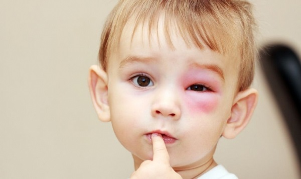 Foto - Ailelerin korkulu rüyası! Alerjik çocuklar için 14 altın tavsiye