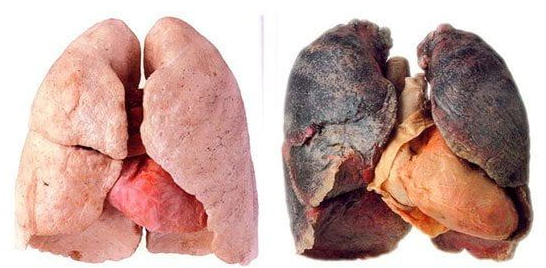 Foto - Akciğerdeki katranı ve nikotini arındıran efsane karışım: Günde 1 bardak her gün içerseniz! Kökünden kurutuyor