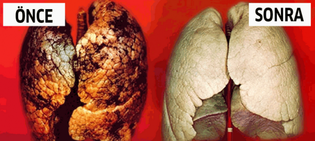 Foto - Akciğerdeki katranı ve nikotini arındıran efsane karışım: Günde 1 bardak her gün içerseniz! Kökünden kurutuyor