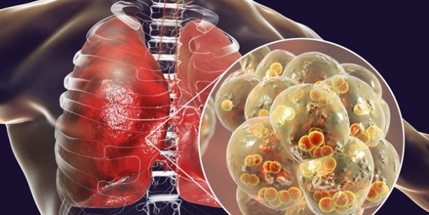 Akciğerleri temizleyen besinler! Akciğerleri yeniden doğmuş gibi yapıyor ve zatürreden kurtarıyor