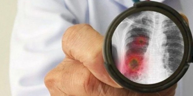 Foto - Akciğerlerinizi sıfırlayın: Muhteşem, birebir tutan karışım bakın ne! Uzmanlar tarafından açıklandı: Tertemiz yapıyor