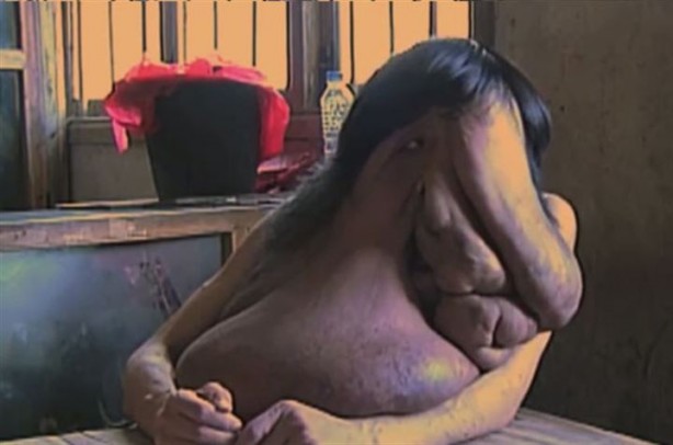 Foto - Akılalmaz hastalıkla 35 yıldır mücadele ediyor