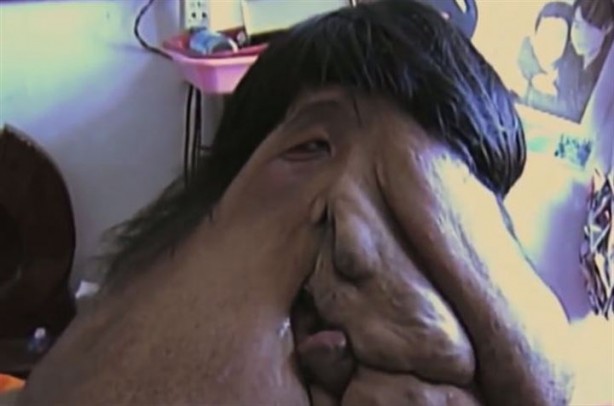 Foto - Akılalmaz hastalıkla 35 yıldır mücadele ediyor