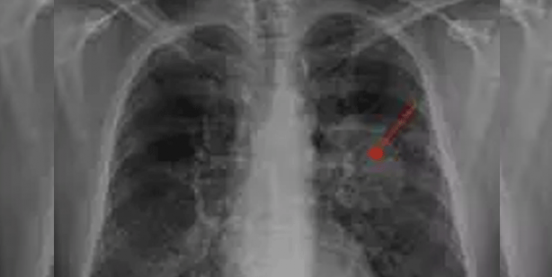 Akıllara durgunluk veren olay: Doktorlar tümör sanıp çıkardıkları şeyi görünce şaşırdı