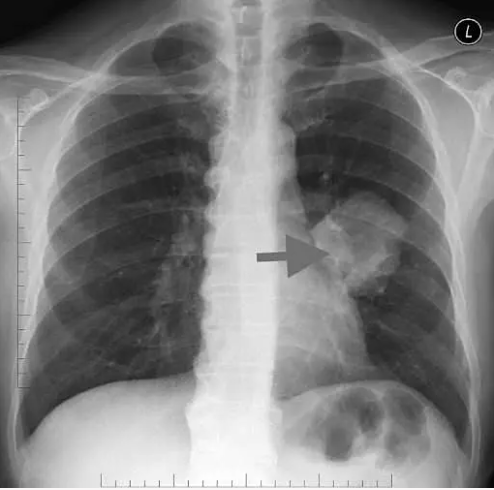 Foto - Akıllara durgunluk veren olay: Doktorlar tümör sanıp çıkardıkları şeyi görünce şaşırdı
