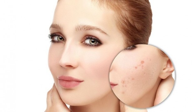 Foto - Akneler hakkında yanlış bilinen 20 yanlış