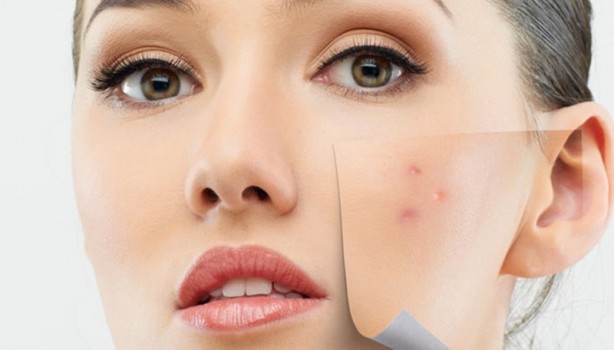 Foto - Akneler hakkında yanlış bilinen 20 yanlış