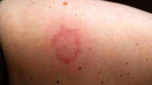 Foto - Akrep, arı, yılan ve deniz canlısı ısırdığında ne yapılmalı? Sürekli kaza yaşayanalar, hazır olun çare bulundu