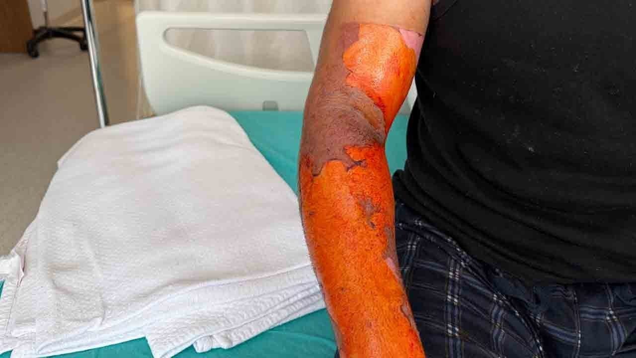 Foto - Aküsü patladı, vücudunun yüzde 25’i yandı: Kasisten geçince kabusu yaşadı