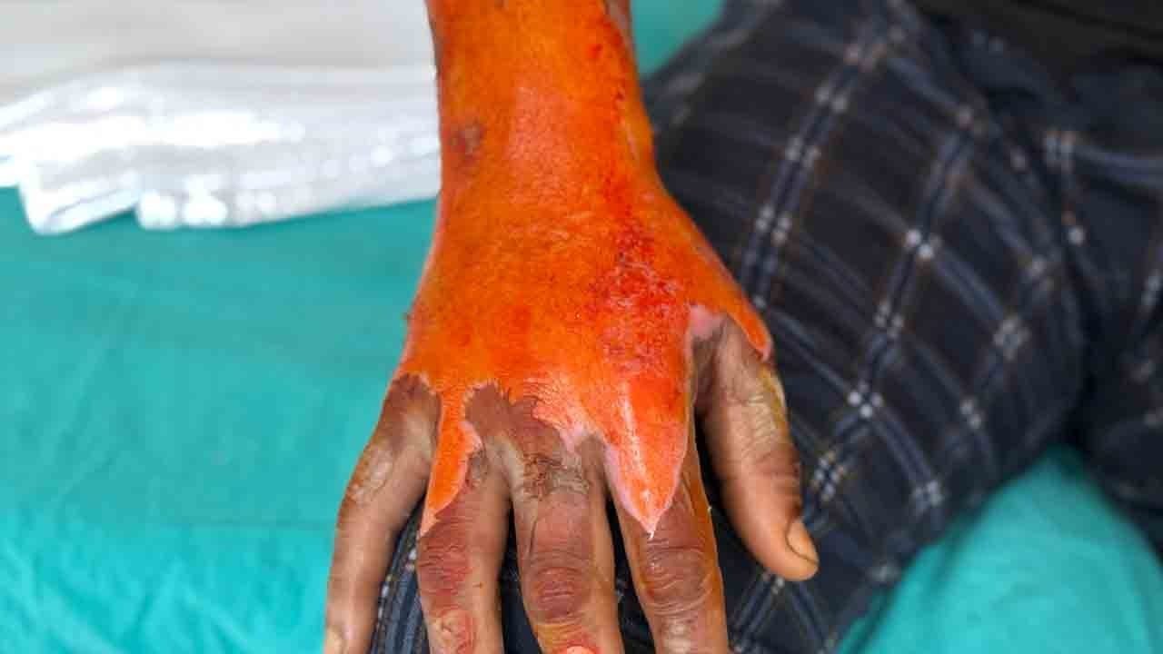 Foto - Aküsü patladı, vücudunun yüzde 25’i yandı: Kasisten geçince kabusu yaşadı