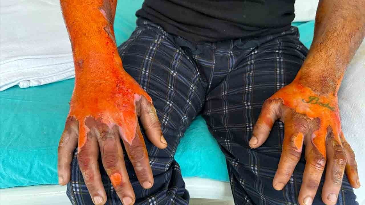 Aküsü patladı, vücudunun yüzde 25’i yandı: Kasisten geçince kabusu yaşadı