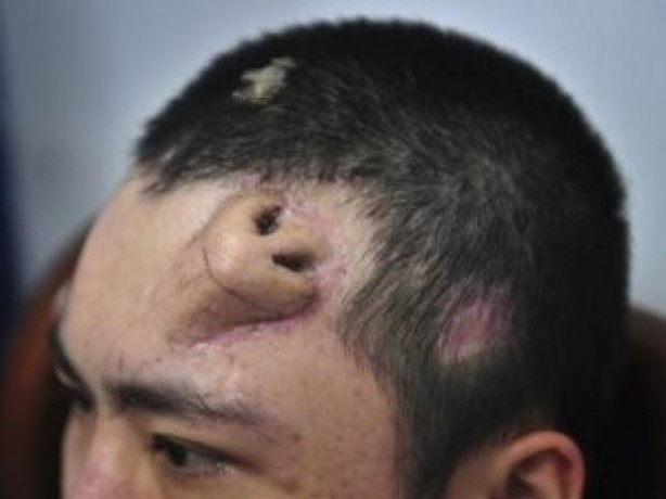 Foto - Alnında burun çıktı