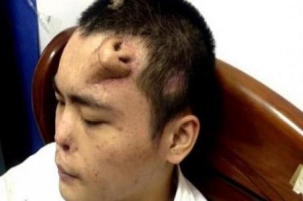 Foto - Alnında burun çıktı