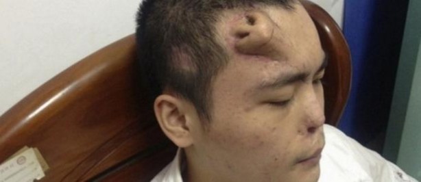 Foto - Alnında burun çıktı