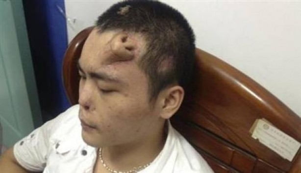 Foto - Alnında burun çıktı