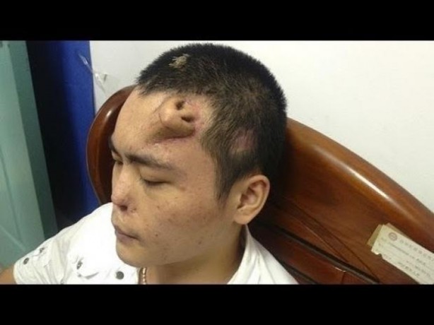 Alnında burun çıktı