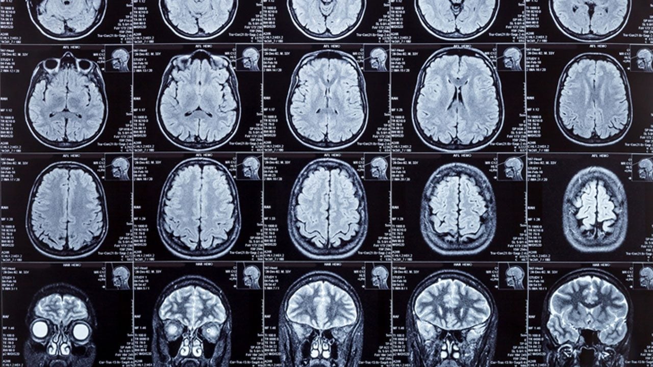 Foto - Alzheimer araştırmalarında heyecanlandıran keşif ! Beyinde daha önce bilinmeyen "temizlik ağı" bulundu
