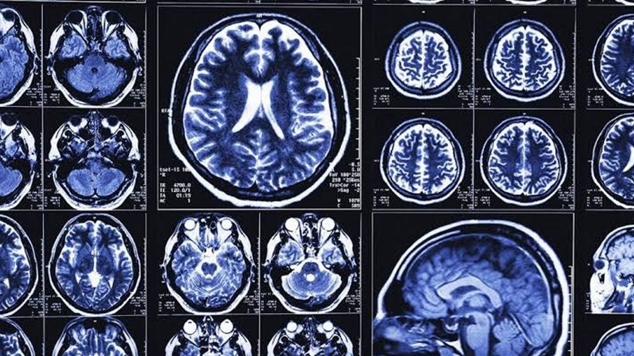 Foto - Alzheimer araştırmalarında heyecanlandıran keşif ! Beyinde daha önce bilinmeyen "temizlik ağı" bulundu