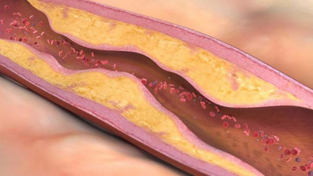 Foto - Alzheimer'ı önlemek için bunlara dikkat etmelisiniz!