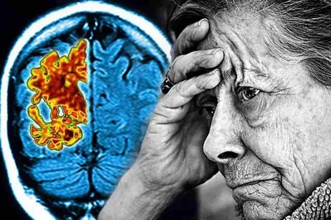 Foto - Alzheimer’ın ana sebebi bulundu! Bu alışkanlıklarınız varsa dikkat