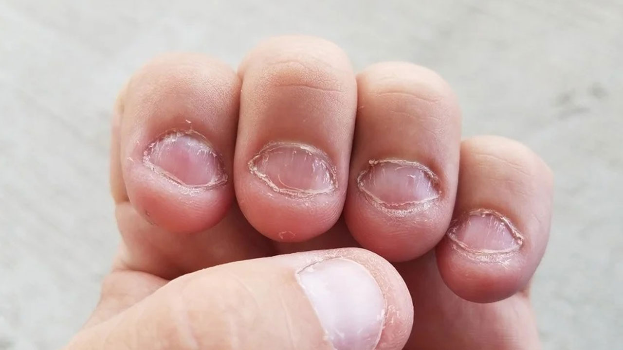 Foto - Aman çok dikkatli olun! Tırnak yemenin gizli tehlikesi