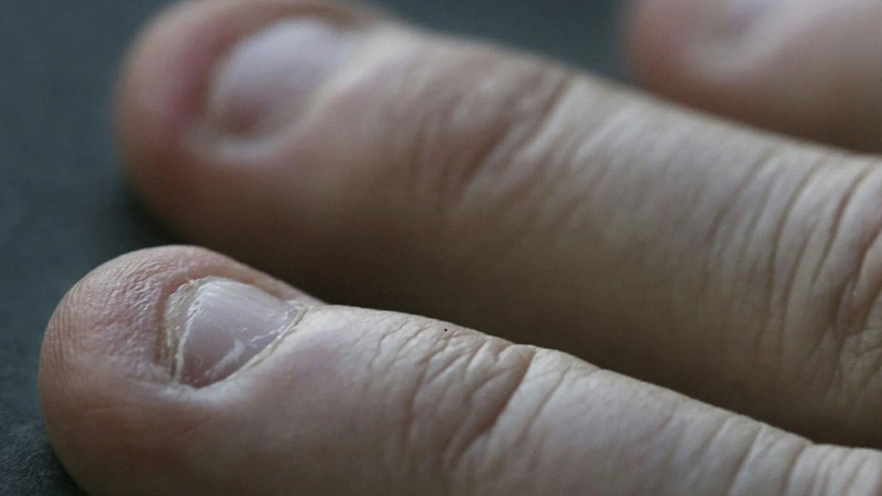 Foto - Aman çok dikkatli olun! Tırnak yemenin gizli tehlikesi