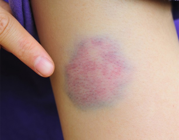 Foto - Aman dikkat! Çorabınız bileğinizde iz bırakıyorsa...