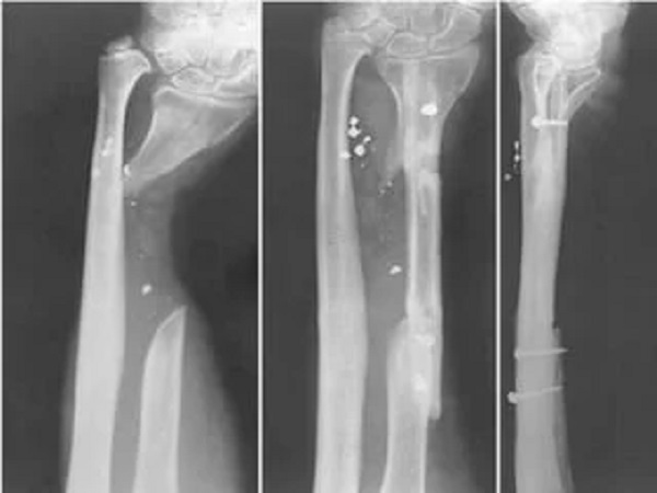 Foto - Aman dikkat edin! Bu hastalık çok sinsi ilerliyor