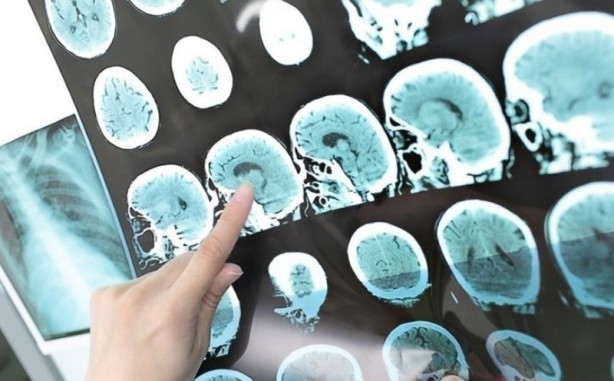 Foto - Beyin tümörünün habercisi olan bu belirtilere aman dikkat!