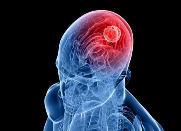 Foto - Beyin tümörünün habercisi olan bu belirtilere aman dikkat!
