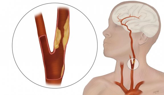 Foto - Aman dikkat! Rutin kontroller çok önemli! Kalp hastalıklarından sonra ikinci sırada! Ölüm riski oldukça fazla!