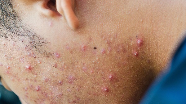 Foto - Aman dikkat! Sivilce izlerinden kurtulmak istiyorsanız sakın bunları yapmayın