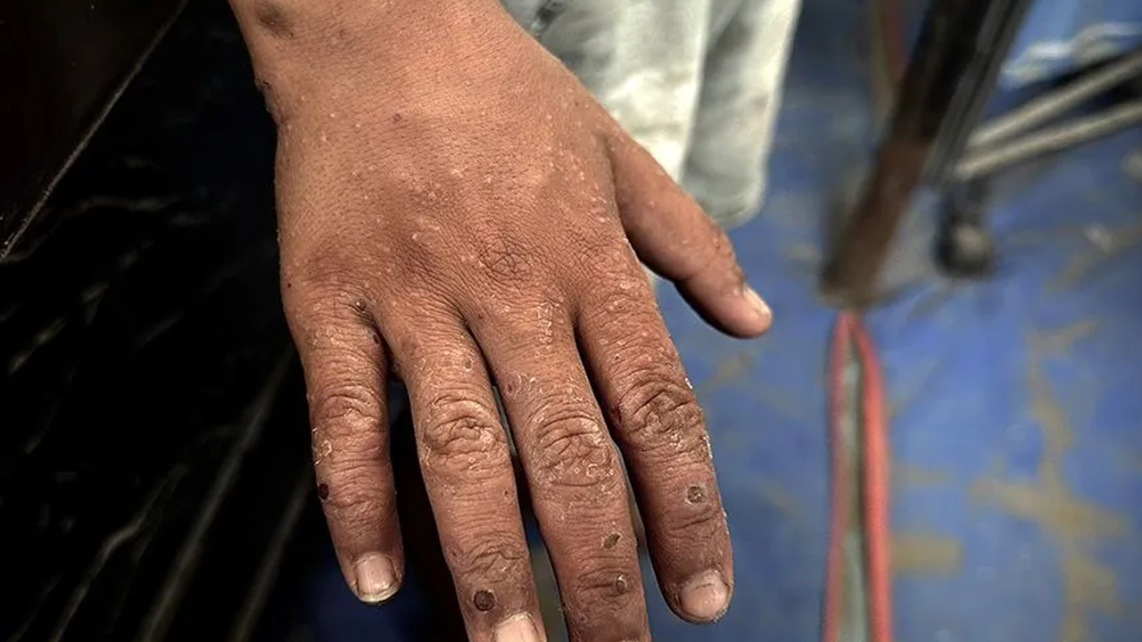 Foto - Aman dikkat! Vaka sayısı artıyor! Bu hastalık temas yoluyla bulaşıyor