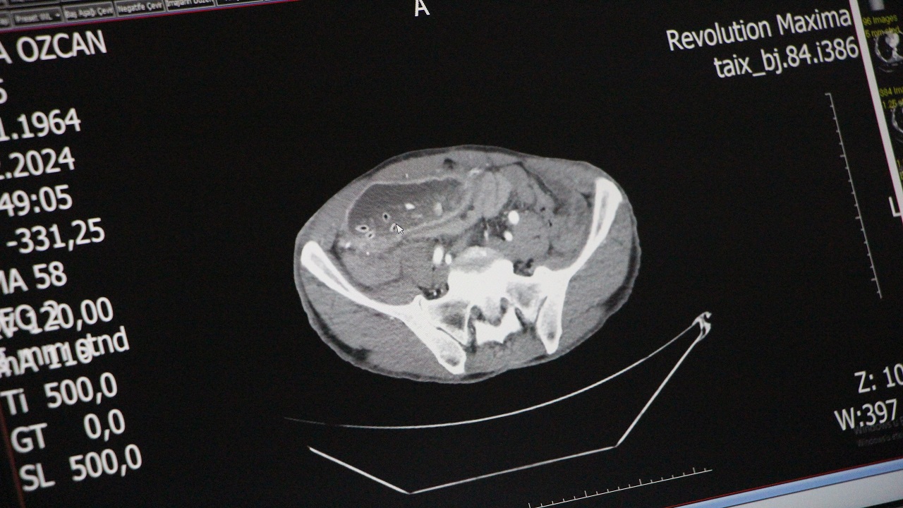 Ameliyatla hayatı değişti! Midesi 10 kat büyüdü, yıllarca yemek yiyemedi