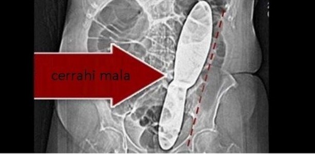 Foto - Ameliyatlarda hastaların içinde unutulan enteresan şeyler!